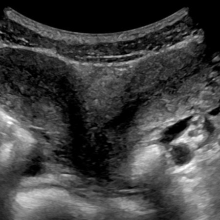 mulher com dois úteros