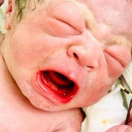 Bebê nasce segurando DIU que estava no útero da mãe